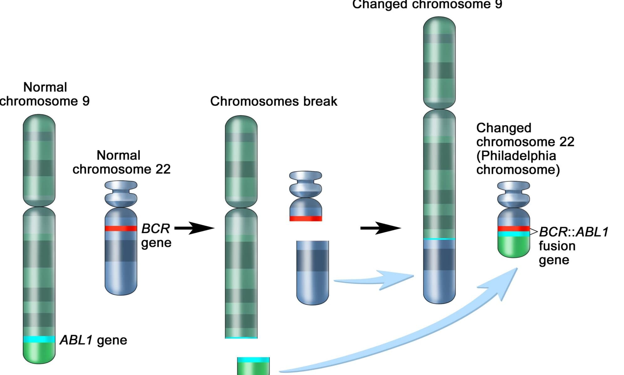 Philadelphia chromosome